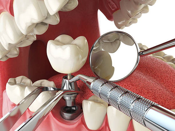 Best Emergency Dentist for Lost Fillings or Crowns in Kraemer, LA